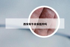 西安有牛皮癣医院吗