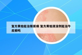 复方黄柏能治银屑病 复方黄柏液涂剂能治牛皮癣吗