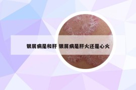 银屑病是和肝 银屑病是肝火还是心火