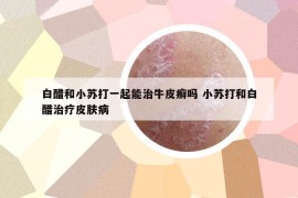 白醋和小苏打一起能治牛皮癣吗 小苏打和白醋治疗皮肤病