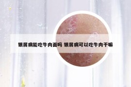 银屑病能吃牛肉面吗 银屑病可以吃牛肉干嘛