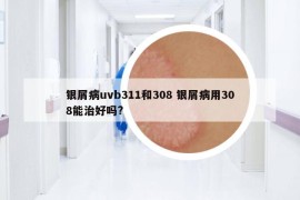 银屑病uvb311和308 银屑病用308能治好吗?
