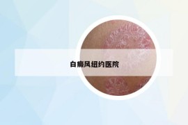 白癜风纽约医院