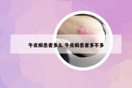牛皮癣患者多么 牛皮癣患者多不多