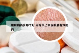 银屑病药膏哪个好 治疗头上银皮癣最有效的药