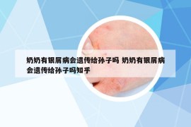 奶奶有银屑病会遗传给孙子吗 奶奶有银屑病会遗传给孙子吗知乎