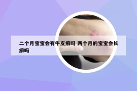 二个月宝宝会有牛皮癣吗 两个月的宝宝会长癣吗