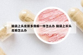脑袋上头皮屑多像癣一样怎么办 脑袋上长头皮癣怎么办