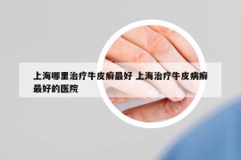 上海哪里治疗牛皮癣最好 上海治疗牛皮病癣最好的医院