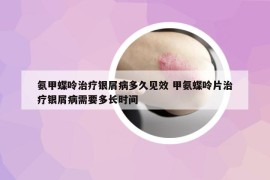 氨甲蝶呤治疗银屑病多久见效 甲氨蝶呤片治疗银屑病需要多长时间