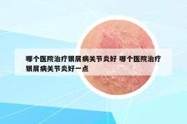 哪个医院治疗银屑病关节炎好 哪个医院治疗银屑病关节炎好一点