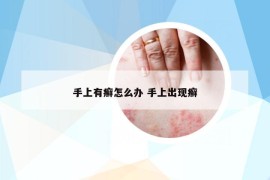 手上有癣怎么办 手上出现癣