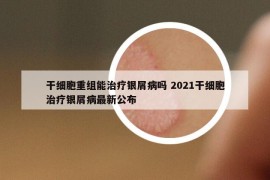 干细胞重组能治疗银屑病吗 2021干细胞治疗银屑病最新公布