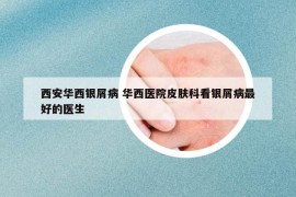 西安华西银屑病 华西医院皮肤科看银屑病最好的医生