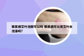 银屑病艾叶泡脚可以吗 银屑病可以用艾叶水泡澡吗?