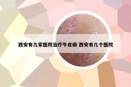 西安有几家医院治疗牛皮癣 西安有几个医院