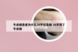 牛皮癣患者为什么30岁还发病 30岁得了牛皮癣
