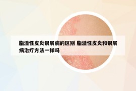 脂溢性皮炎银屑病的区别 脂溢性皮炎和银屑病治疗方法一样吗