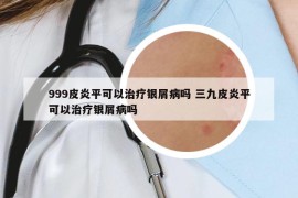 999皮炎平可以治疗银屑病吗 三九皮炎平可以治疗银屑病吗