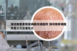 潍坊哪里看银屑病最权威医院 潍坊银屑病医院是公立还是私立