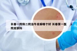 长春一院和二院治牛皮癣哪个好 长春第一医院皮肤科