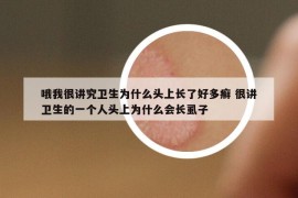 哦我很讲究卫生为什么头上长了好多癣 很讲卫生的一个人头上为什么会长虱子