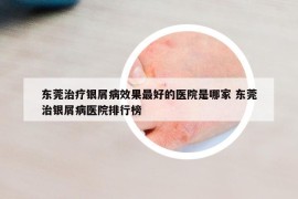 东莞治疗银屑病效果最好的医院是哪家 东莞治银屑病医院排行榜