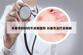 长春市较好的牛皮癣医院 长春市治疗皮肤癣