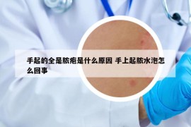 手起的全是脓疱是什么原因 手上起脓水泡怎么回事