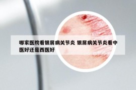 哪家医院看银屑病关节炎 银屑病关节炎看中医好还是西医好