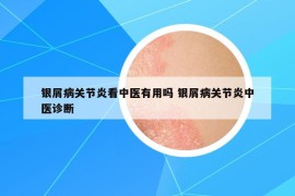 银屑病关节炎看中医有用吗 银屑病关节炎中医诊断