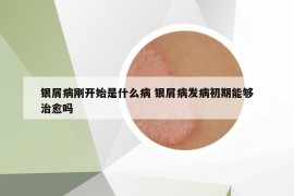 银屑病刚开始是什么病 银屑病发病初期能够治愈吗