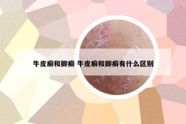 牛皮癣和脚癣 牛皮癣和脚癣有什么区别
