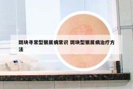 斑块寻常型银屑病常识 斑块型银屑病治疗方法