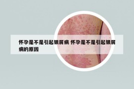 怀孕是不是引起银屑病 怀孕是不是引起银屑病的原因