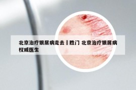 北京治疗银屑病走去徳胜门 北京治疗银屑病权威医生