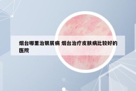 烟台哪里治银屑病 烟台治疗皮肤病比较好的医院