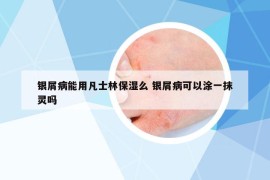银屑病能用凡士林保湿么 银屑病可以涂一抹灵吗