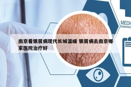 南京看银屑病现代长城温暖 银屑病去南京哪家医院治疗好