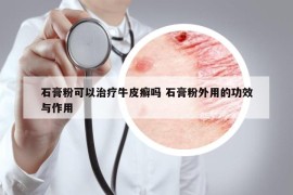 石膏粉可以治疗牛皮癣吗 石膏粉外用的功效与作用