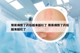 银屑病擦了药后越来越红了 银屑病擦了药后越来越红了