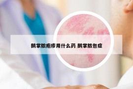 鹅掌脓疱疹用什么药 鹅掌脓包症