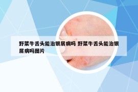 野菜牛舌头能治银屑病吗 野菜牛舌头能治银屑病吗图片