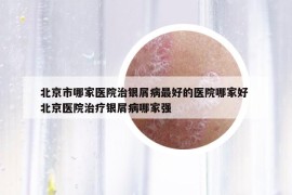 北京市哪家医院治银屑病最好的医院哪家好 北京医院治疗银屑病哪家强