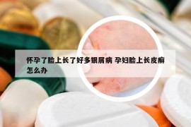 怀孕了脸上长了好多银屑病 孕妇脸上长皮癣怎么办