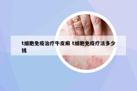 t细胞免疫治疗牛皮癣 t细胞免疫疗法多少钱