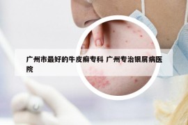 广州市最好的牛皮癣专科 广州专治银屑病医院