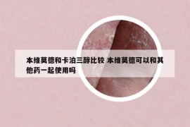 本维莫德和卡泊三醇比较 本维莫德可以和其他药一起使用吗