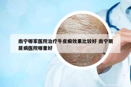 南宁哪家医院治疗牛皮癣效果比较好 南宁银屑病医院哪里好