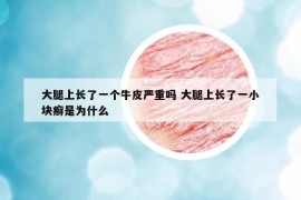 大腿上长了一个牛皮严重吗 大腿上长了一小块癣是为什么